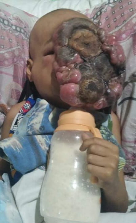 baby john child face tumor cancer philippines