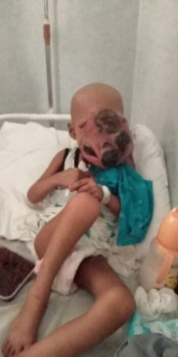 baby john child face tumor cancer philippines chemo