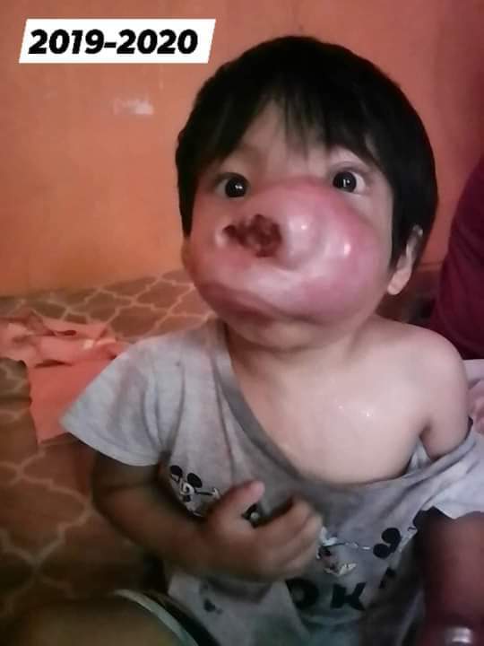 baby john child face tumor cancer philippines chemo