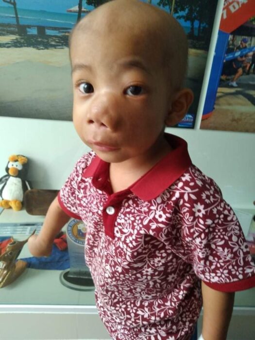 baby john child face tumor cancer philippines chemo