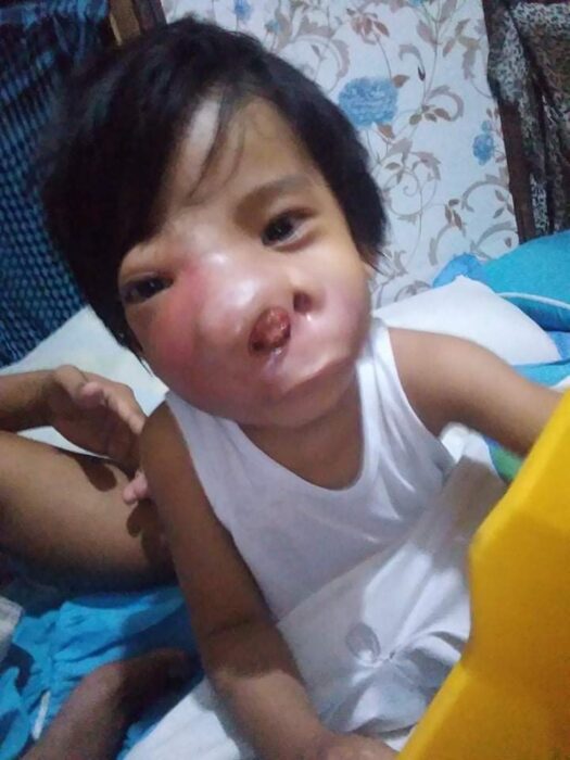 baby john child face tumor cancer philippines chemo