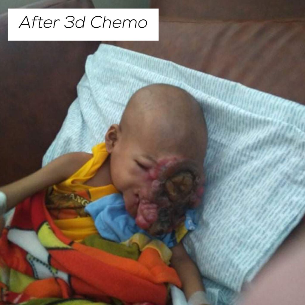 baby john child face tumor cancer philippines