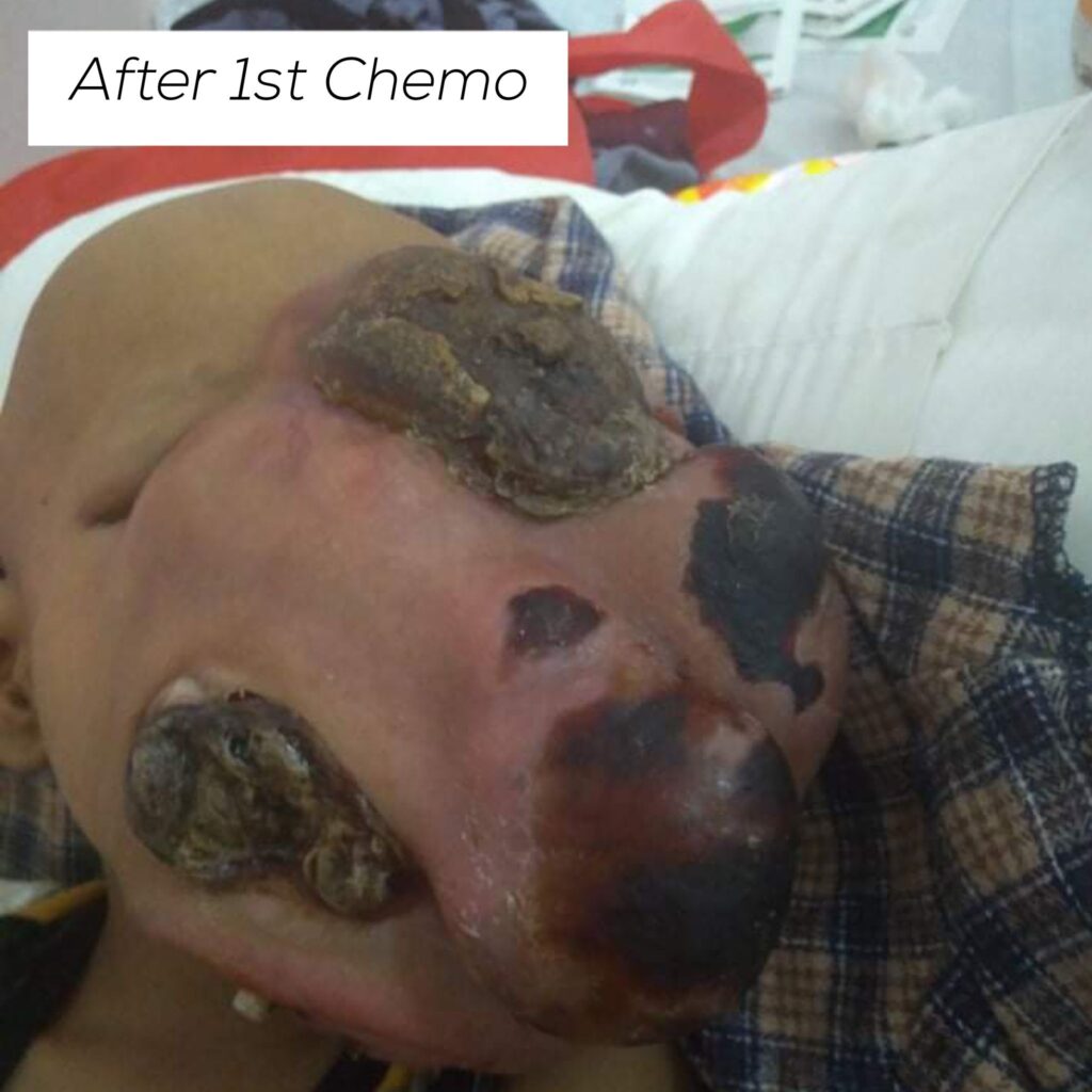 baby john child face tumor cancer philippines