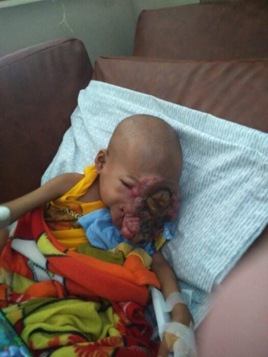 baby john child face tumor cancer philippines chemo