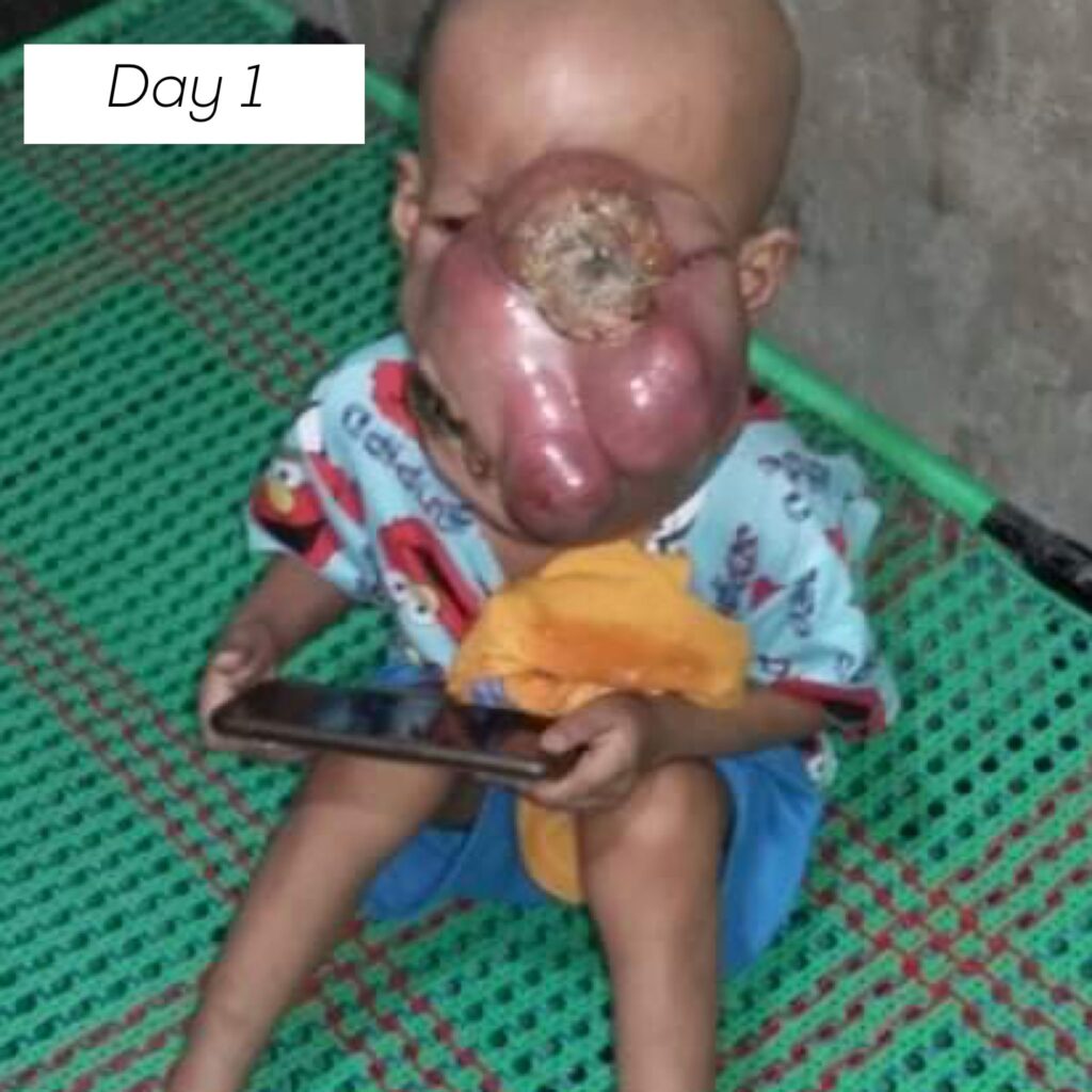 baby john child face tumor cancer philippines chemo