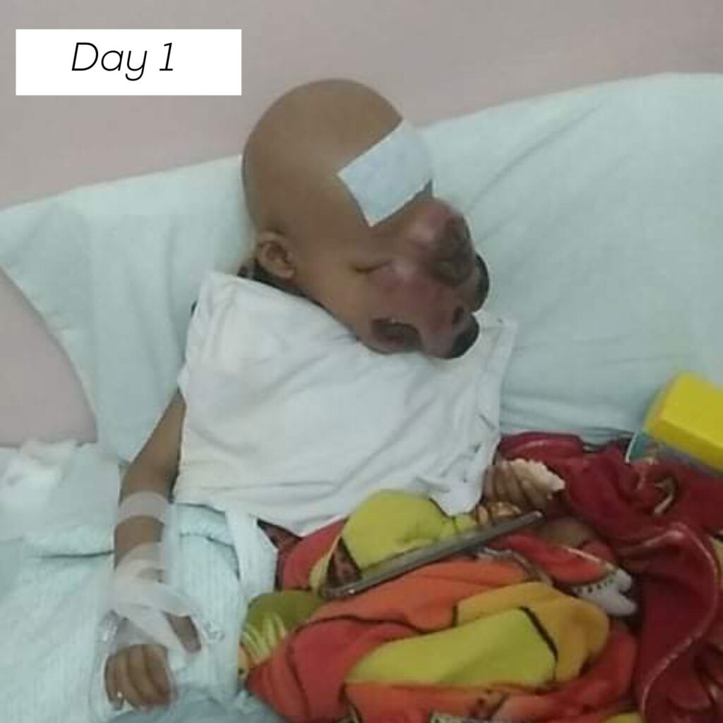baby john child face tumor cancer philippines chemo