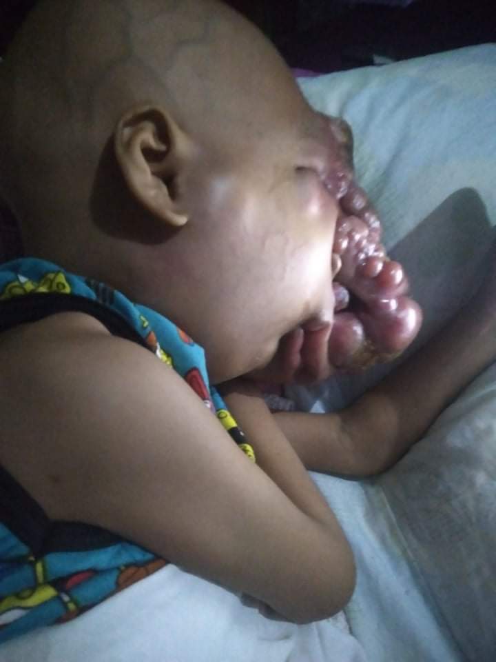 baby john child face tumor cancer philippines